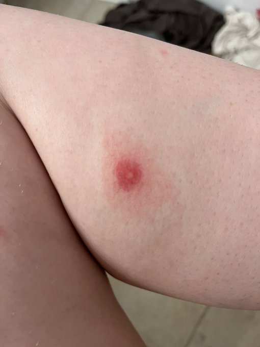 I have the craziest bug bite https://t.co/i1v5TrLWlz