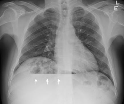 Frontline Gastro (@frontgastro_bmj) on Twitter photo Our very own associate TAE <a href="/RexWHHui/">Rex Wan-Hin Hui</a> and team describe an interesting case of a sub-diaphragmatic air-fluid level 👇
bit.ly/3GaxWEs
<a href="/sheiybani/">Gio McGinty</a> <a href="/MohsenSubhani/">Mohsen Subhani</a> <a href="/VivekGoodoory/">Vivek Goodoory</a> <a href="/DunnePdj/">Philip Dunne</a> <a href="/DrJMKennedy/">James Kennedy</a> <a href="/RMBeattie50/">Mark Beattie</a> Our very own associate TAE <a href="/RexWHHui/">Rex Wan-Hin Hui</a> and team describe an interesting case of a sub-diaphragmatic air-fluid level 👇
bit.ly/3GaxWEs
<a href="/sheiybani/">Gio McGinty</a> <a href="/MohsenSubhani/">Mohsen Subhani</a> <a href="/VivekGoodoory/">Vivek Goodoory</a> <a href="/DunnePdj/">Philip Dunne</a> <a href="/DrJMKennedy/">James Kennedy</a> <a href="/RMBeattie50/">Mark Beattie</a>