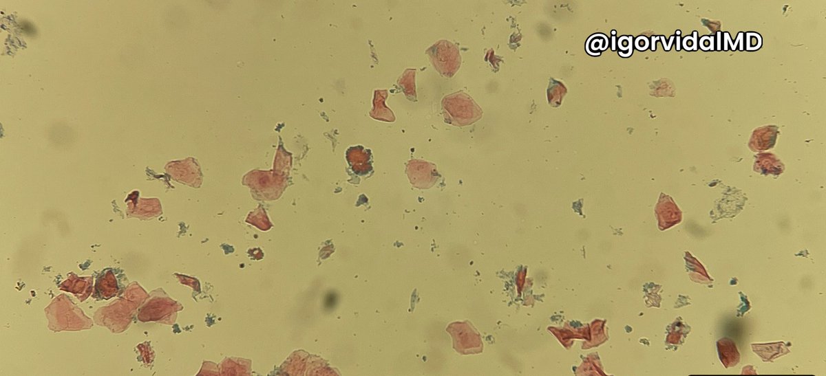 igorvidalMD's tweet photo. The pictures below are representative of an Anal Pap smear. What is the conclusion and why?
#pathparlor #cytology #cytopath #cytopathology #pathtwitter #medtwitter #MedEd https://t.co/kpR8hucb8t