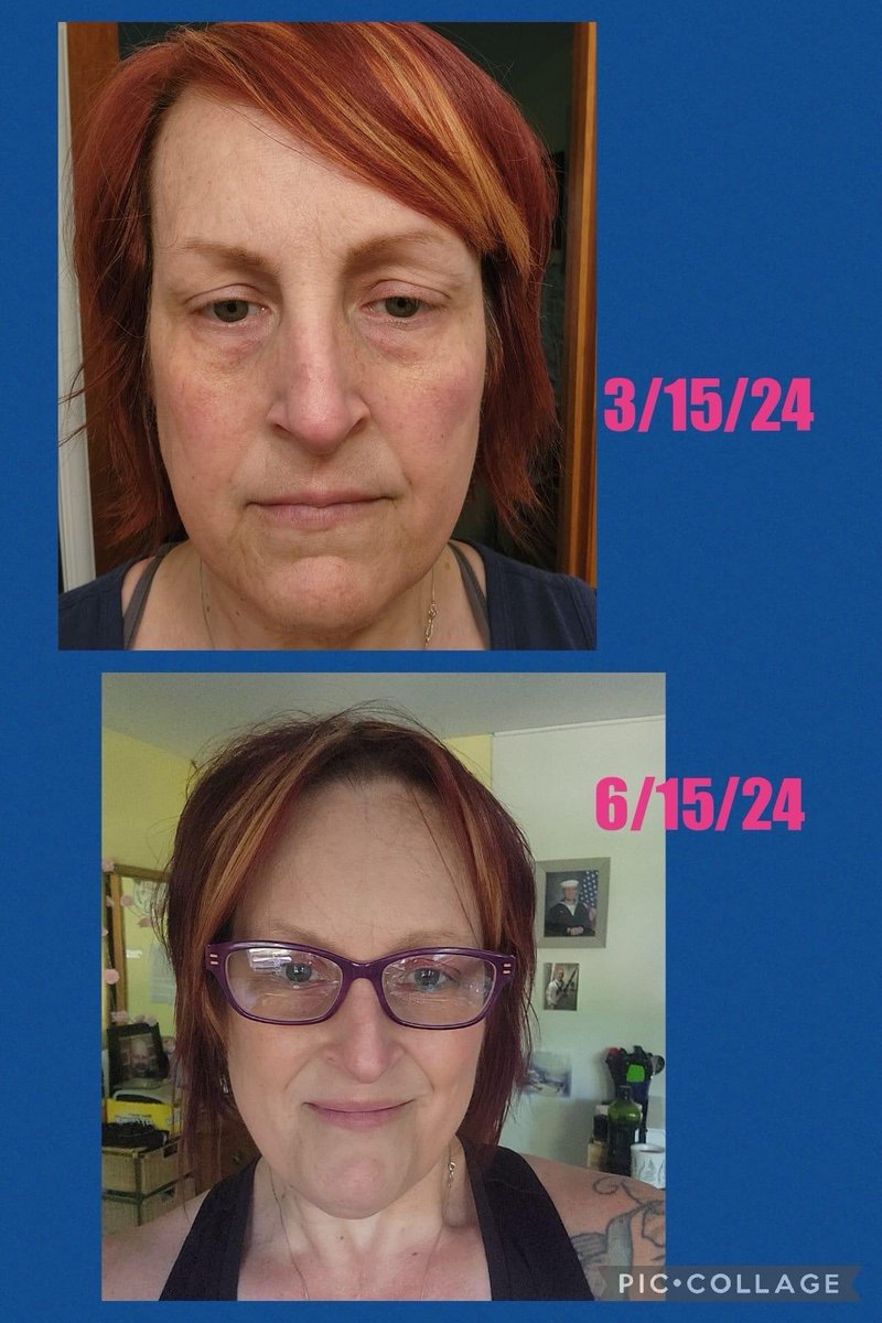 Witness the magic of nootropics and frequencies! 🌟 3 months in, and the transformation is mind-blowing. Feel the surge of energy and inner rejuvenation. Don’t wait—unlock these benefits now and let your natural glow light up! #TransformationTuesday #WellnessJourney #Nootropics