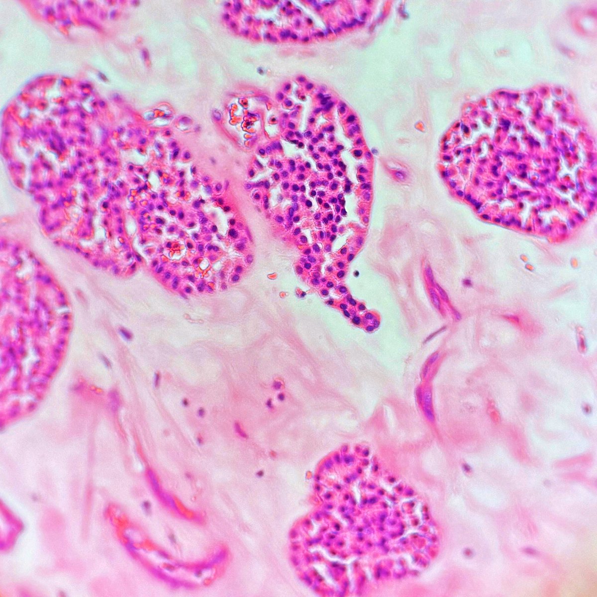 xenaalabbas's tweet image. 68 y.o man #Oncocytoma #Nephropath #renalpath #pathology #macroscopy #microscopy