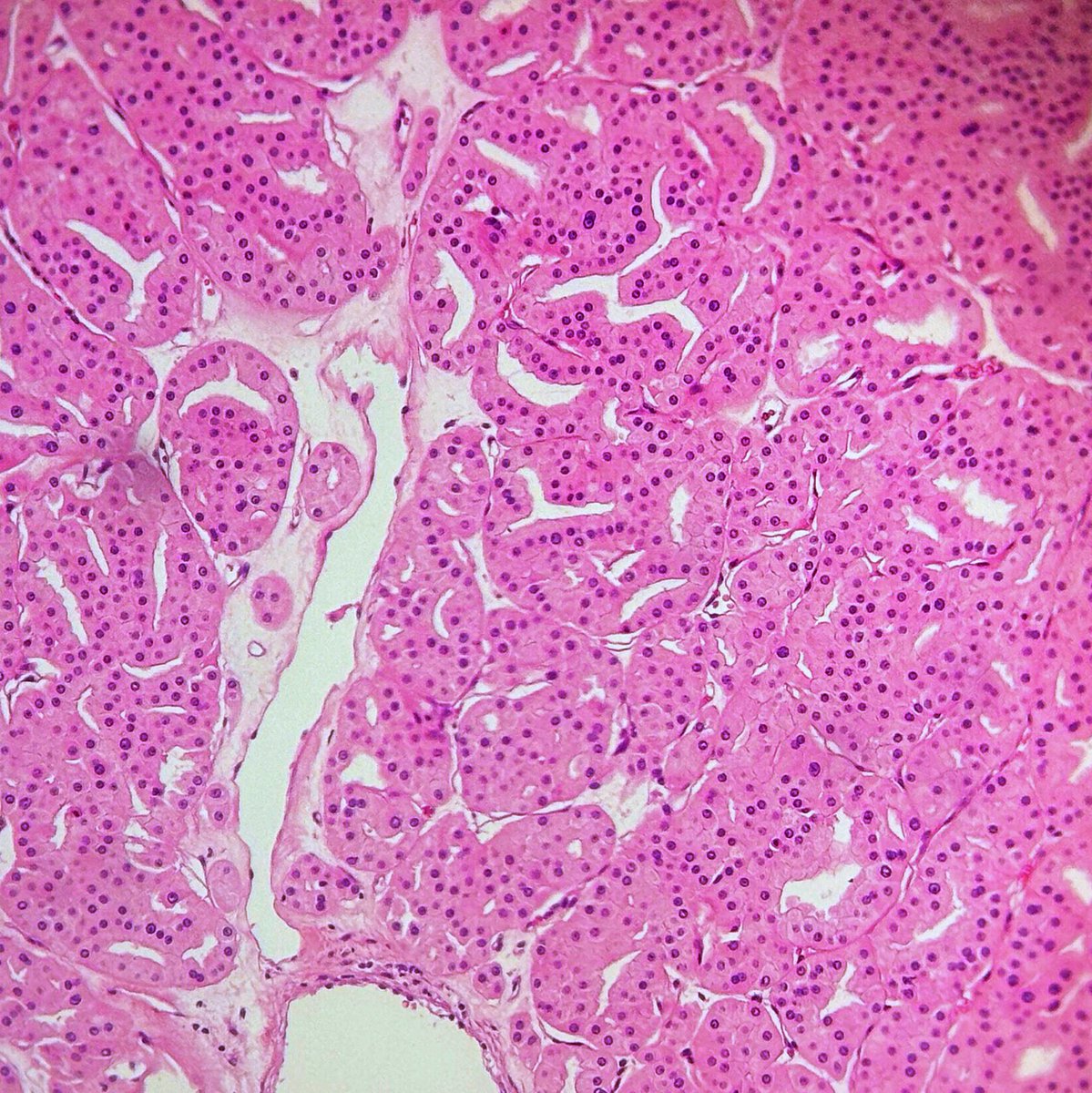 xenaalabbas's tweet image. 68 y.o man #Oncocytoma #Nephropath #renalpath #pathology #macroscopy #microscopy