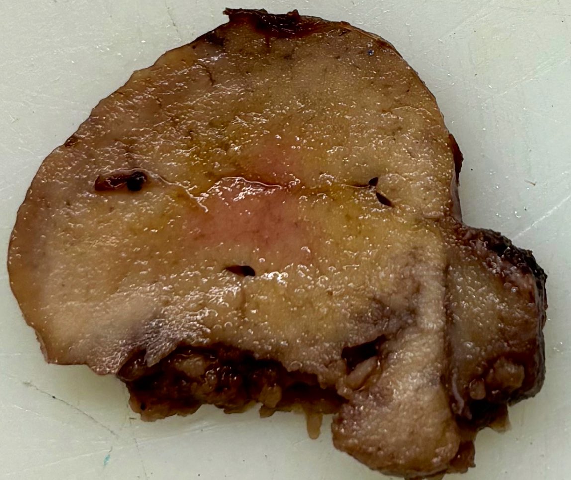 xenaalabbas's tweet image. 68 y.o man #Oncocytoma #Nephropath #renalpath #pathology #macroscopy #microscopy