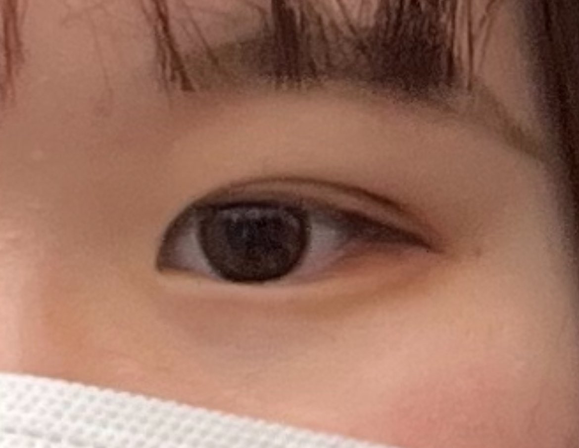 rguvs___'s tweet photo. 恵聖会のおめめです
埋没×目頭切開
もうすぐ1年 https://t.co/jH3WPyQ4BO
