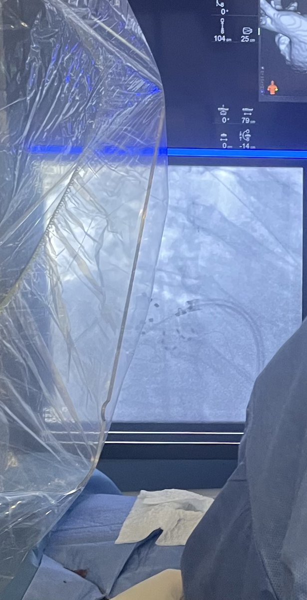 Iniciado esta semana con #PFA 
Clínica universidad de Navarra, Pamplona-España. <a href="/bayiron123/">Ignacio García-Bolao</a> <a href="/feliperamosmd/">Felipe Ramos</a> <a href="/chenfo88/">César Daniel Niño P</a>