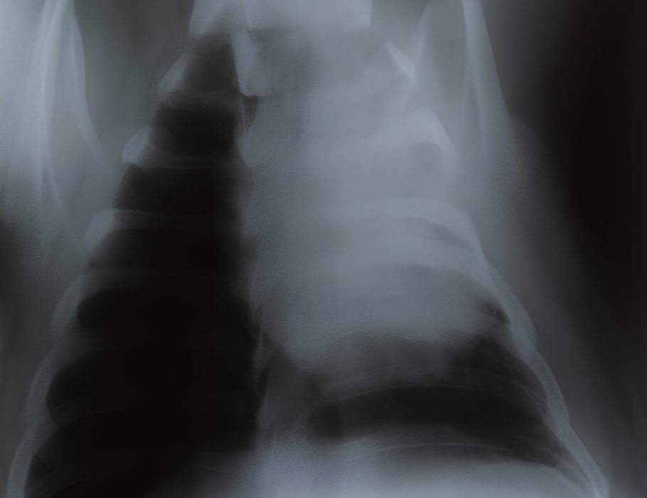 ScienceTM's tweet image. Employing #GeneEngineering to knock down swine leukocyte antigens, researchers show they can promote the survival of #LungTransplants in pigs for as long as 2 years while avoiding the need for immune-suppressing drugs. @RainerBlasczyk @MHH_life scim.ag/7Ky