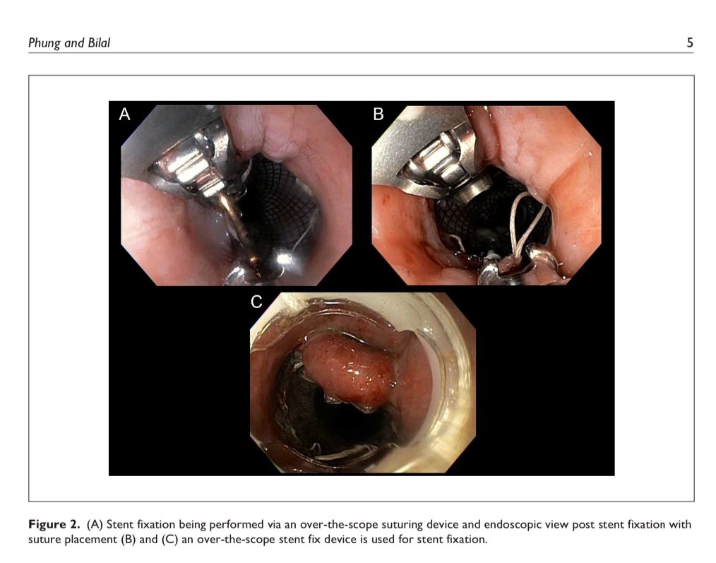 Mohammad Bilal, MD (@bilalmohammadmd) on Twitter photo #EsophagealStenting isnt technically challenging
But several factors to consider
✅ Stent Diameter Select
✅ TTS vs Fluoro guided stents
✅ Stent fixation
✅ Benign vs Malignant
Great work by #JensonPhung sharing practical tips in <a href="/foregut_journal/">Foregut Journal</a>
📎 journals.sagepub.com/doi/abs/10.117… #EsophagealStenting isnt technically challenging
But several factors to consider
✅ Stent Diameter Select
✅ TTS vs Fluoro guided stents
✅ Stent fixation
✅ Benign vs Malignant
Great work by #JensonPhung sharing practical tips in <a href="/foregut_journal/">Foregut Journal</a>
📎 journals.sagepub.com/doi/abs/10.117…