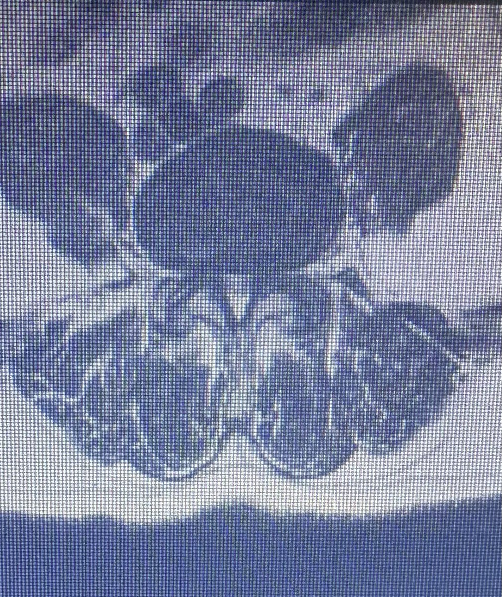 When the sagittal view don’t show us how severe is the stenosis. It’s necessary to evaluate the axial view that is indispensable for an accurate and complete diagnosis of conditions affecting the lumbar spine, providing crucial information that complements sagittal and coronal
