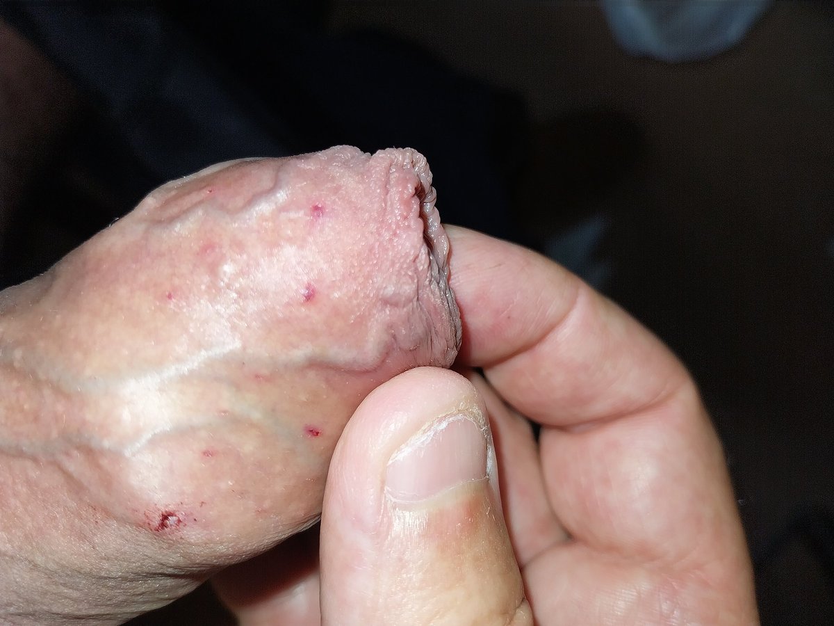 johnbsub's tweet photo. 1st picture is of the staple mark and the 2nd picture is of the marks made by the No8 octopus hook.

Thanks to @Madame_Li_Ying for stretching my boundaries today https://t.co/8AtXHK9flA