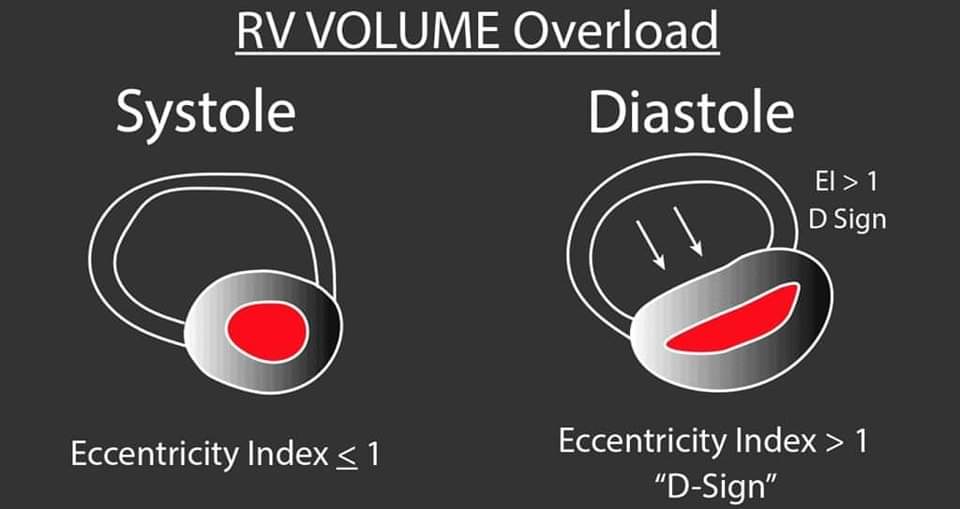 ZHeart11768530's tweet photo. 🔴 The D Sign – Right Heart Strain from Pressure vs Volume Overload

🔸Differentiating between RV pressure and volume overloads 👌🏼

 🔸https://t.co/IiYMTkFP11
 #medtwitterWhat #MedTwitter #CardioEd #medx #medEd #CardioTwitter #cardiotwitter #MedX #MedEd #cardiology https://t.co/xXXobA5qLi