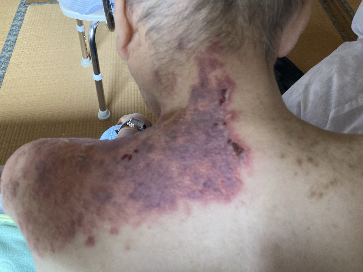 adgjmpt09600711's tweet photo. ワ◯チン💉打った父
帯状疱疹で入院しました
2年たった今も痒い痒いと…本当に可哀想です https://t.co/ansIOshwN4