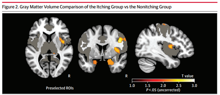 Itching of undetermined origin may indicate the presence of a neurodegenerative process. In this study, a higher occurrence of itching was observed in patients w/ patients with frontotemporal degeneration spectrum disorder compared w/ Alzheimer disease. ja.ma/3SkBx9z