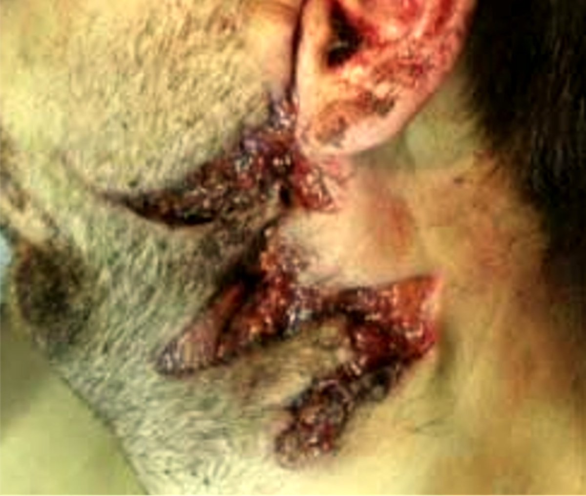 @mikenov: tangential gunshot wounds to upper ear from AR-15 rifle https://www.google.com/search?newwindow=1&sca_esv=2a19a3414e05e997&sca_upv=1&rlz=1C1ONGR_enUS949US949&sxsrf=ADLYWILNsG77DkHubaR976fvTf3qbbdtFg:1721666148102&q=tangential+gunshot+wounds+to+upper+ear+from+AR-15+rifle&source=lnms&fbs=AEQNm0COabAucIQdzGgOV6zyCH49114ne6VEuJbL5isfzp-vzH3haa7CPqgEUHwcUrktU3Kx3XZBiknUfd3ri4NmaiAkDUi2mptHpLfMS6Tw7Wym1cPeqbSmYToeSccOUbkY9Oy5ceqDaMGzIR_ckEIpN8vUnx_IsmCoZ8bmYvlp-sd5iVHnRS1cxCU0aOJCaO6Xe6sSztqDCYJhowJcl_mDXGmOkkMluA&sa=X&ved=2ahUKEwj7rbeZiruHAxXemYkEHVn4AnYQ0pQJegQIDhAB&biw=1536&bih=695&dpr=1.25