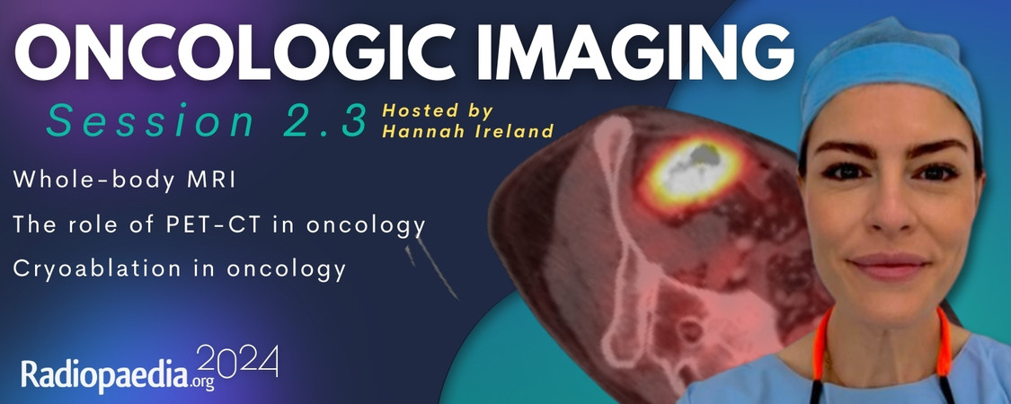 Dr Amish Lakhani (@dr_a_lakhani) on Twitter photo Excited to share my take on #wholebodyMRI at #Radiopaedia2024 tomorrow during the Oncologic Imaging session (2.3), hosted by the fantastic
<a href="/Hannah_Ireland/">Hannah Ireland</a> <a href="/Radiopaedia/">Radiopaedia.org</a> Excited to share my take on #wholebodyMRI at #Radiopaedia2024 tomorrow during the Oncologic Imaging session (2.3), hosted by the fantastic
<a href="/Hannah_Ireland/">Hannah Ireland</a> <a href="/Radiopaedia/">Radiopaedia.org</a>