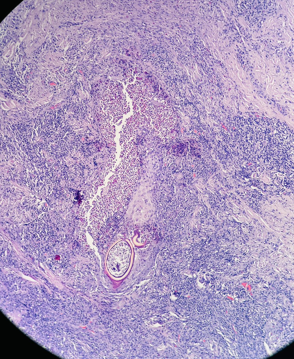 HENRYY_MD's tweet image. OUCH! Be aware … something is biting you..
#dermapath #tickbite
@mccalmo @JacobSmalberger @david_terrano @et565 @MarcelaSaebL @gonzadetoro @kis_lorand @SGottesmanMD @tonitatirado