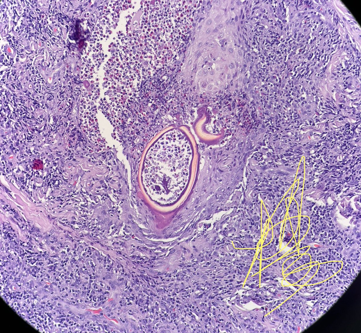 HENRYY_MD's tweet image. OUCH! Be aware … something is biting you..
#dermapath #tickbite
@mccalmo @JacobSmalberger @david_terrano @et565 @MarcelaSaebL @gonzadetoro @kis_lorand @SGottesmanMD @tonitatirado