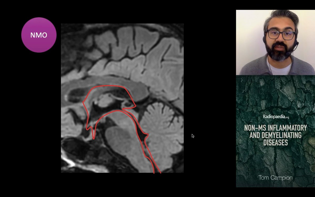 piandro3142's tweet photo. NMOSD/MOGAD pearls from @tmcampion, day 1 #Radiopaedia2024:
- In the NMOSD brain, look for periependymal changes, reflecting AQP4 distribution
- FLAMES is an evolving MOGAD phenotype (maybe FUEL too)
- Anterior optic neuritis with perineuritis is typical of MOGAD https://t.co/uBfKESiCtC