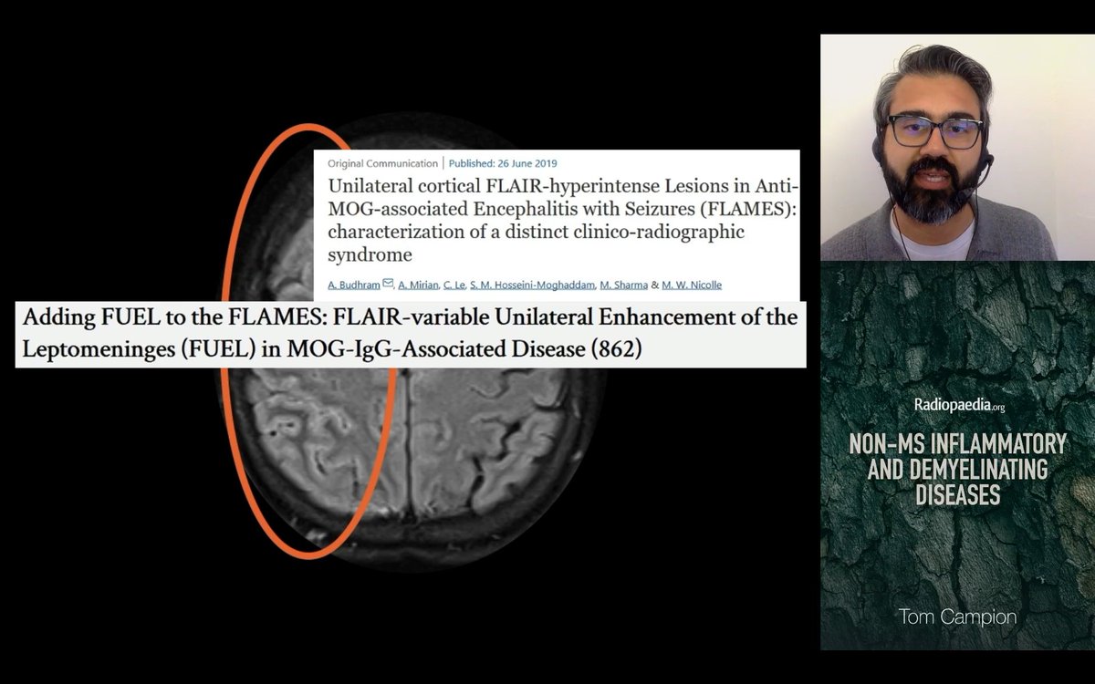 piandro3142's tweet photo. NMOSD/MOGAD pearls from @tmcampion, day 1 #Radiopaedia2024:
- In the NMOSD brain, look for periependymal changes, reflecting AQP4 distribution
- FLAMES is an evolving MOGAD phenotype (maybe FUEL too)
- Anterior optic neuritis with perineuritis is typical of MOGAD https://t.co/uBfKESiCtC