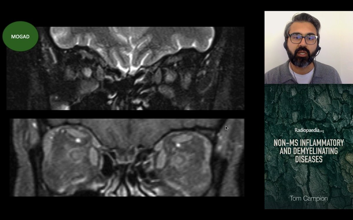 Rohit Sharma (@piandro3142) on Twitter photo NMOSD/MOGAD pearls from <a href="/tmcampion/">Tom Campion</a>, day 1 #Radiopaedia2024:
- In the NMOSD brain, look for periependymal changes, reflecting AQP4 distribution
- FLAMES is an evolving MOGAD phenotype (maybe FUEL too)
- Anterior optic neuritis with perineuritis is typical of MOGAD NMOSD/MOGAD pearls from <a href="/tmcampion/">Tom Campion</a>, day 1 #Radiopaedia2024:
- In the NMOSD brain, look for periependymal changes, reflecting AQP4 distribution
- FLAMES is an evolving MOGAD phenotype (maybe FUEL too)
- Anterior optic neuritis with perineuritis is typical of MOGAD
