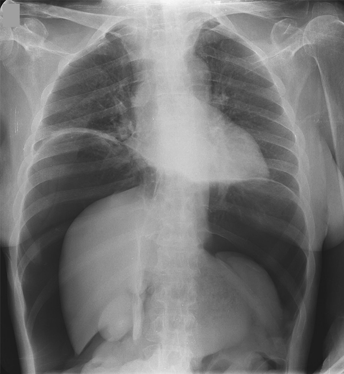 Here’s the most impressive X-Ray of this medical emergency I’ve ever seen 

What’s the diagnosis?
