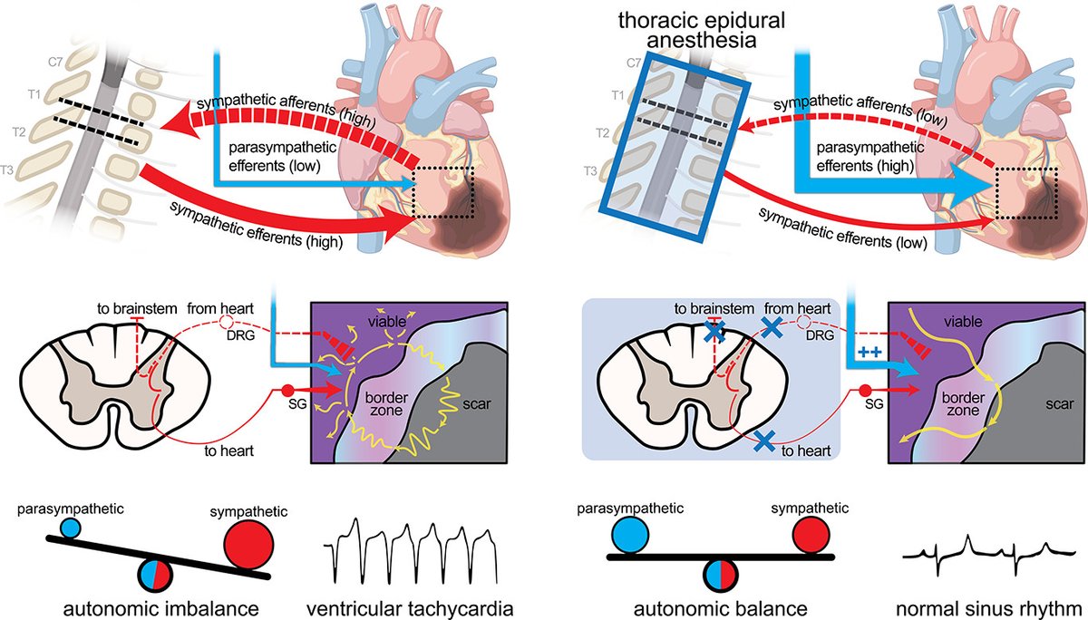 CircRes's tweet photo. Hoang et al found ventricular anti-arrhythmic effects of #epidural anesthesia benefit from improvements in #VagalTone, increasing electrical stability in #infarct border zone regions &amp; tissue refractoriness at https://t.co/E2dNinWU9I 

@JonathanDHoang @MarmarVaseghiMD https://t.co/7vbiOKrQO1
