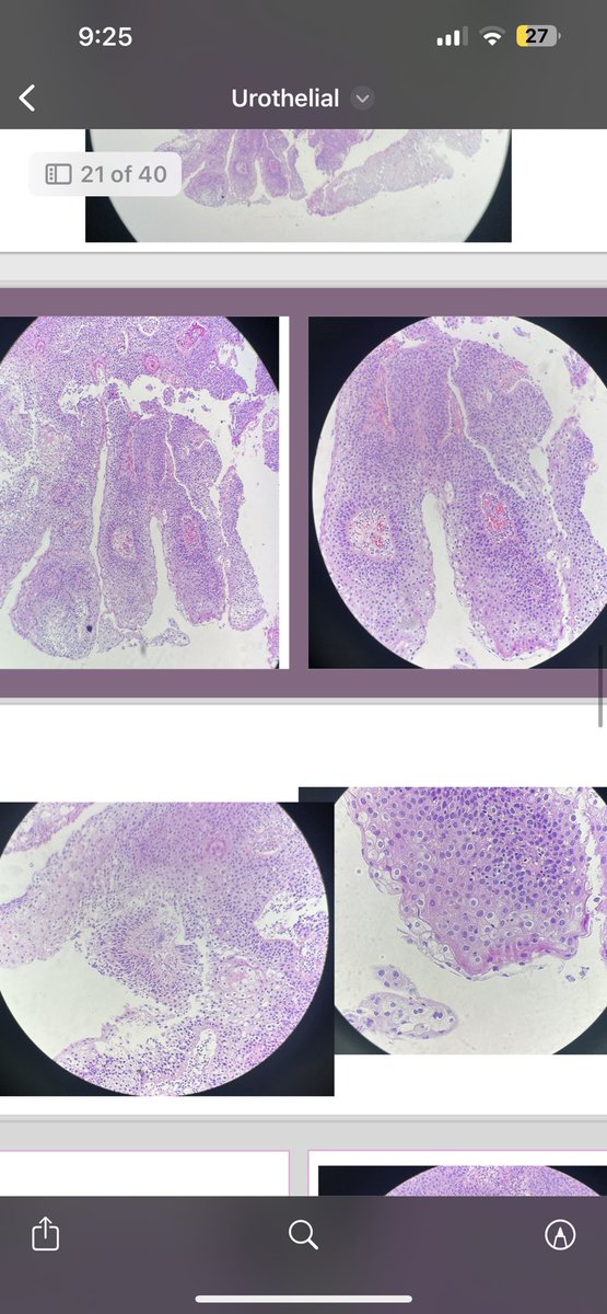 LFpath's tweet image. Bladder mass , different biopsies in the background of bilharzial cystitis #pathology #GUpath #twitterpath