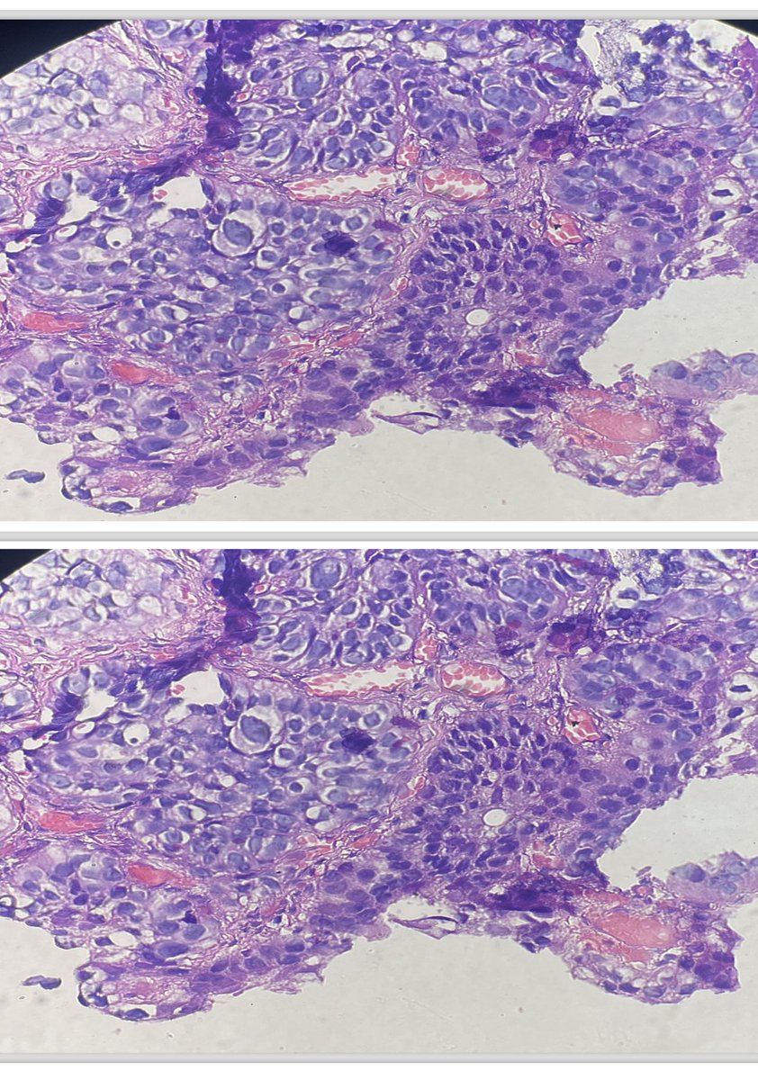 LFpath's tweet image. Bladder mass , different biopsies in the background of bilharzial cystitis #pathology #GUpath #twitterpath
