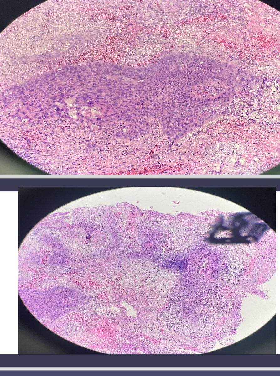 LFpath's tweet image. Bladder mass , different biopsies in the background of bilharzial cystitis #pathology #GUpath #twitterpath