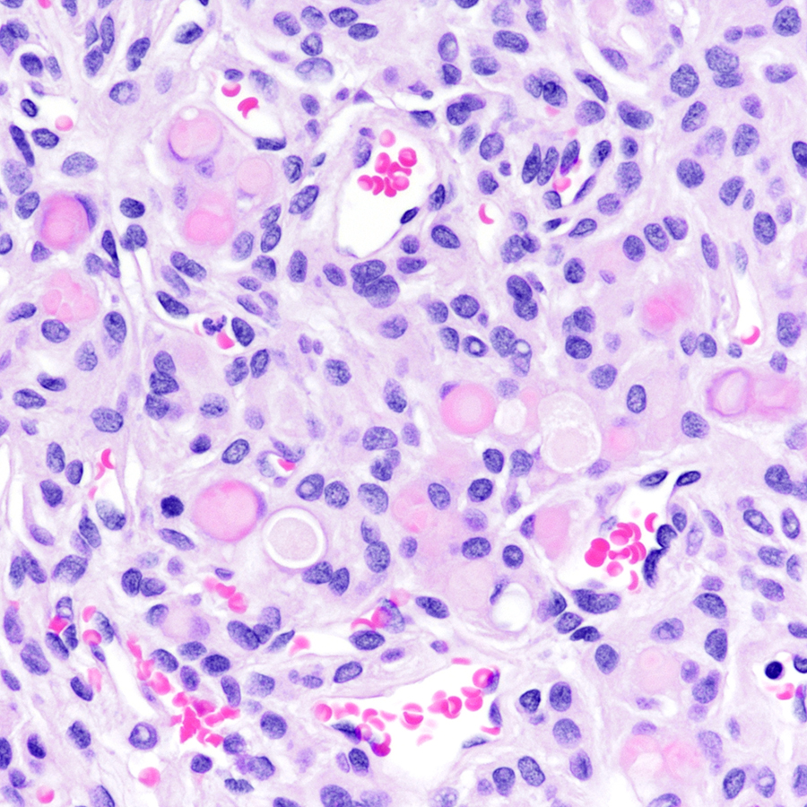 CraigHorbinski's tweet image. Dura-based tumor in an adult. Diagnosis? What mutation might this tumor contain? (It's not a SECRET.) #pathology #neuropath #PathTwitter