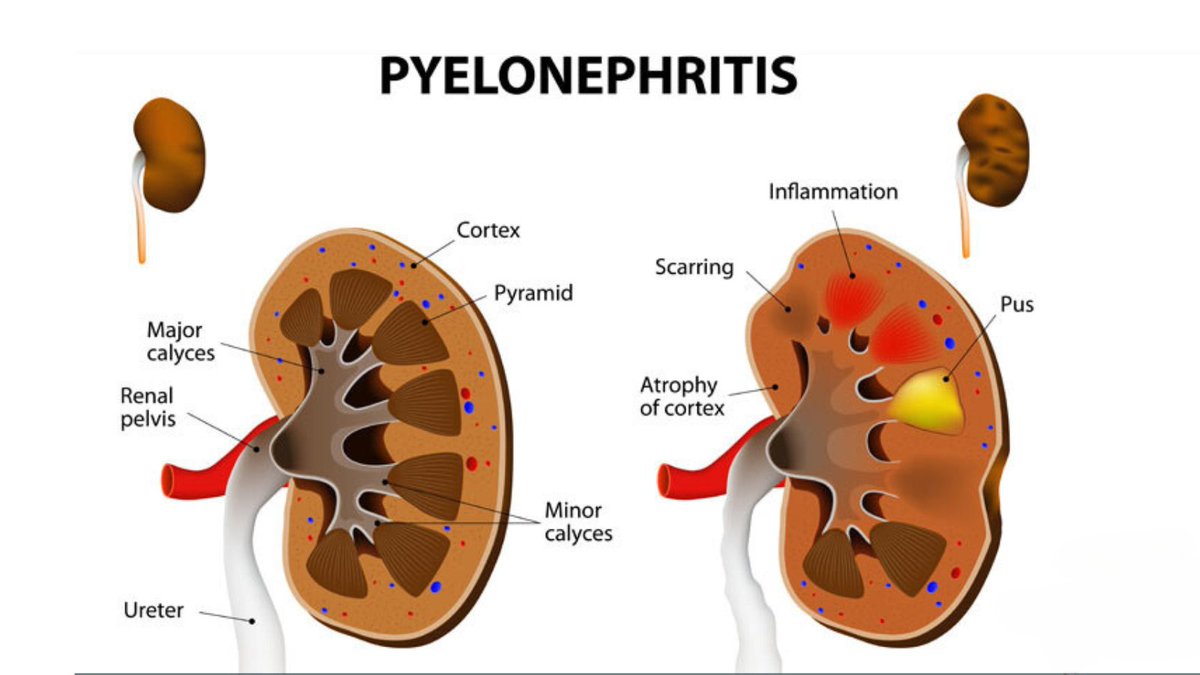 𝐏𝐲𝐞𝐥𝐨𝐧𝐞𝐩𝐡𝐫𝐢𝐭𝐢𝐬 𝐜𝐚𝐮𝐬𝐞𝐬 𝐤𝐢𝐝𝐧𝐞𝐲 𝐢𝐧𝐟𝐥𝐚𝐦𝐦𝐚𝐭𝐢𝐨𝐧:
And can lead to serious complications. Antibiotics and hydration are essential for treatment.#Pyelonephritis #Urology #bladderHealth #nadeembinnusrat #urologistinpakistan #urologycliniconline #kidney
