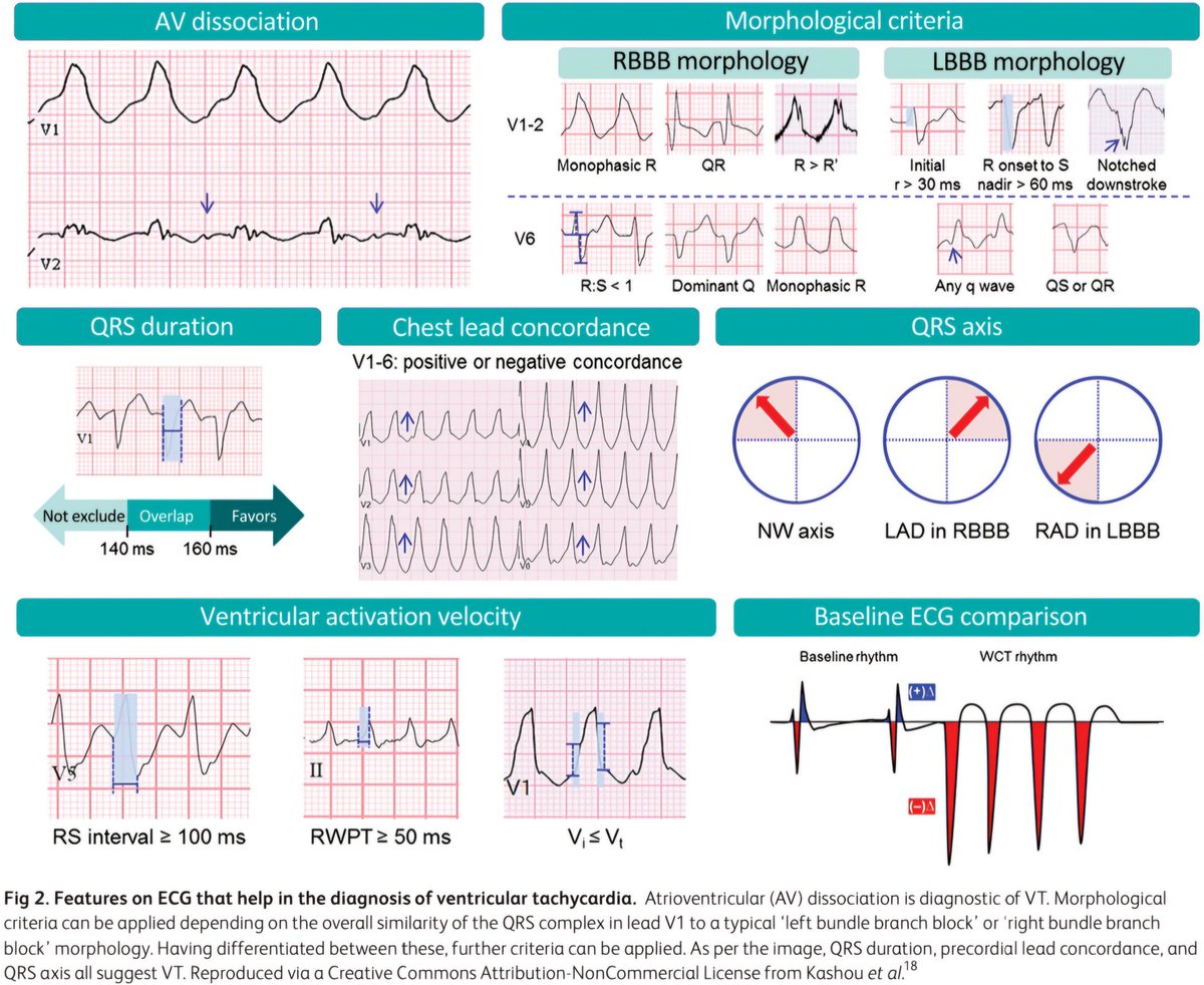 Taquicardia de Complejo Ancho [TCA]. 🫀💢🗯
🟧Al intentar diagnosticar la causa de una TCA, es importante reconocer la probabilidad previa a la prueba de diferentes etiologías qué podrían ser responsables.
🔶️El 80% de las TCA que se presentan finalmente se diagnostican como