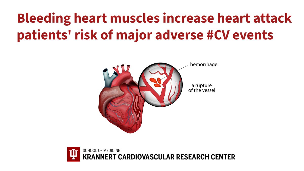 #HemorrhagicMI increases risk for #MACE in #heartattack patients! #IUKrannertHeart <a href="/IUMedSchool/">IU School of Medicine</a> bit.ly/3WxAS7n