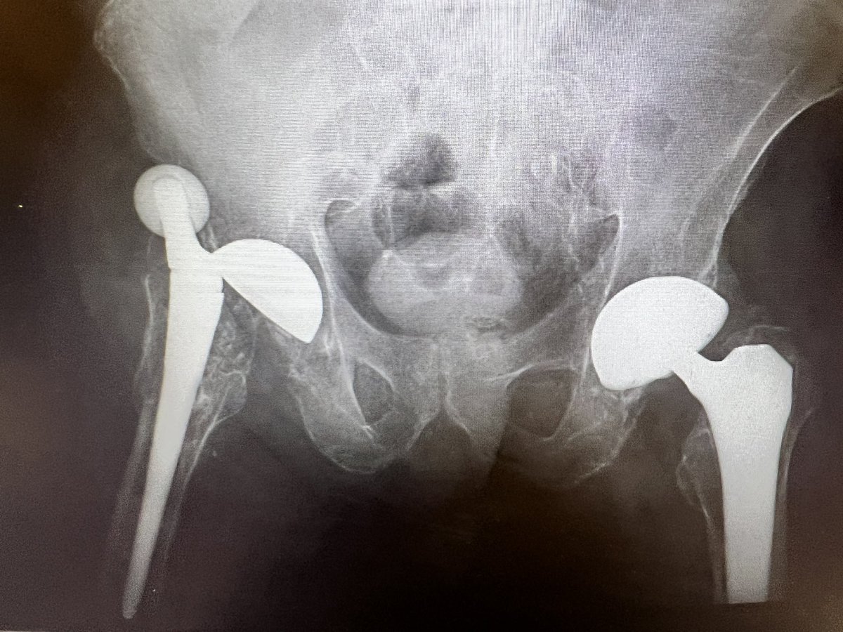 zach_lum's tweet photo. Ortho twitter world, what implant is this?

#orthotwitter https://t.co/DLzEDGPjCo