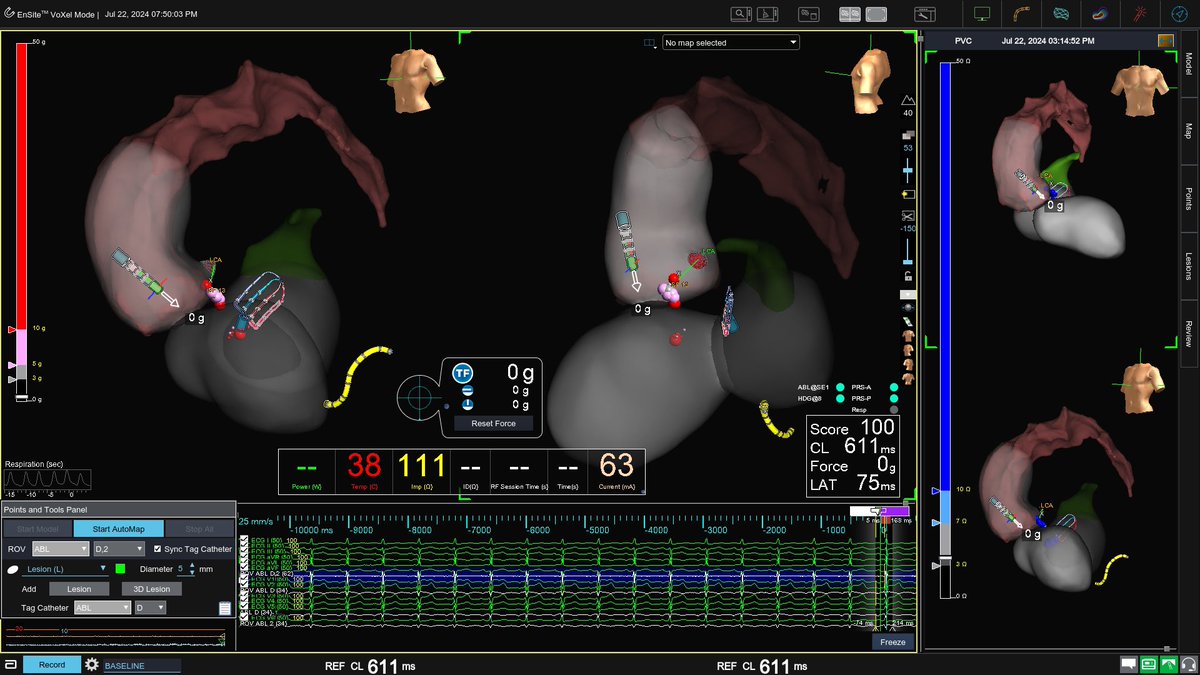 Edward Cheng, MD, PhD (@drepcheng) on Twitter photo intramural LV summit PVC with V2 pattern break, broad exit. Hit it from both LV endocardium and LCC. Half normal NS RF for up to 2 min, ~700 mA current, and anterior ground location critical for success. Excellent mapping <a href="/forkknifecab_EP/">Brock Gambill</a> #EPeeps intramural LV summit PVC with V2 pattern break, broad exit. Hit it from both LV endocardium and LCC. Half normal NS RF for up to 2 min, ~700 mA current, and anterior ground location critical for success. Excellent mapping <a href="/forkknifecab_EP/">Brock Gambill</a> #EPeeps