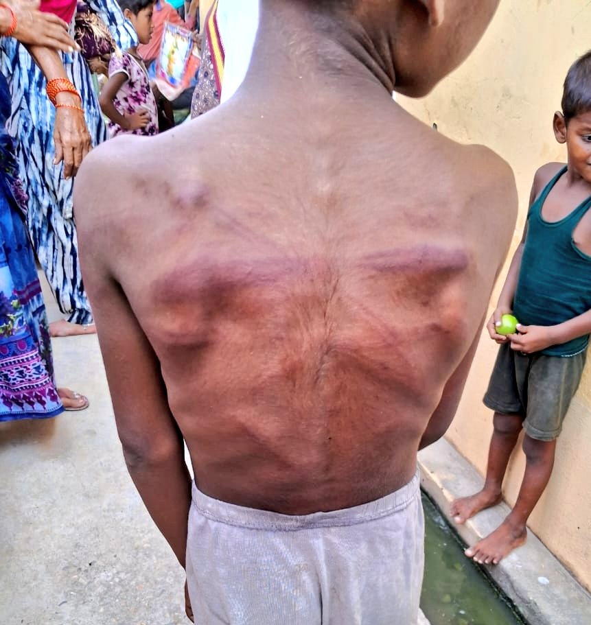 ambedkariteIND's tweet photo. #Horrible A Dalit minor boy brutally beaten by a school teacher. His mistake was that he refused to pluck lemons and Jamuns from the tree in the school for the teacher. The incident happened in Bareilly district of Uttar Pradesh. https://t.co/tUiw80doff