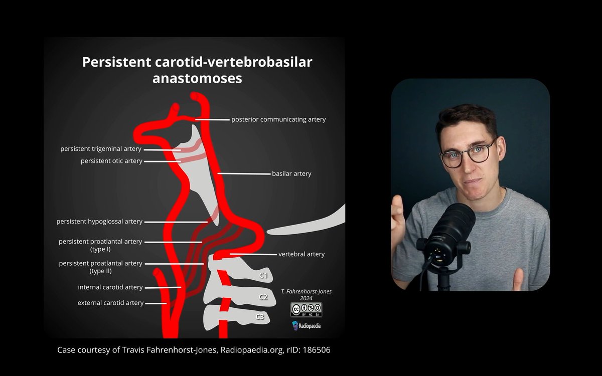Rohit Sharma (@piandro3142) on Twitter photo Incredible explanations and demonstrations of persistent carotid-vertebrobasilar anastomoses by <a href="/radiologytuts/">Michael Nel</a> and <a href="/drcraighacking/">Craig Hacking</a>, day 1 #Radiopaedia2024.
Pearl: start at the aortic arch and track the ant. and post. circulations up one vessel at a time, tedious but worthwhile! Incredible explanations and demonstrations of persistent carotid-vertebrobasilar anastomoses by <a href="/radiologytuts/">Michael Nel</a> and <a href="/drcraighacking/">Craig Hacking</a>, day 1 #Radiopaedia2024.
Pearl: start at the aortic arch and track the ant. and post. circulations up one vessel at a time, tedious but worthwhile!