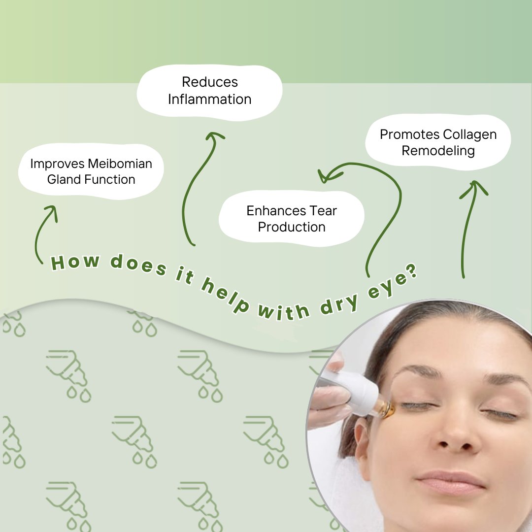 drdanab's tweet photo. Experience the ultimate in dry eye relief and facial rejuvenation at our office. Discover how this cutting-edge treatment can transform your comfort and boost your natural radiance! Book your consultation with us! #dryeye #facialaesthetics #optometrist #eyecare #optometry https://t.co/i1KGZdihyw