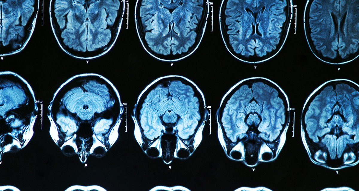 Performing high-intensity interval exercises for just 6 months can improve an older person’s brain function for up to 5 years, according to a new study. wb.md/4fhhgLV