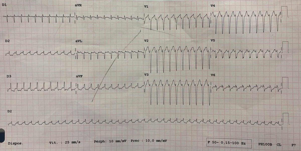 EPWaveDoc's tweet photo. 37 yo guy w palpitations in the #EmergencyRoom. Easy catch? #CardioTwitter #Epeeps https://t.co/O1sSUuWCVr