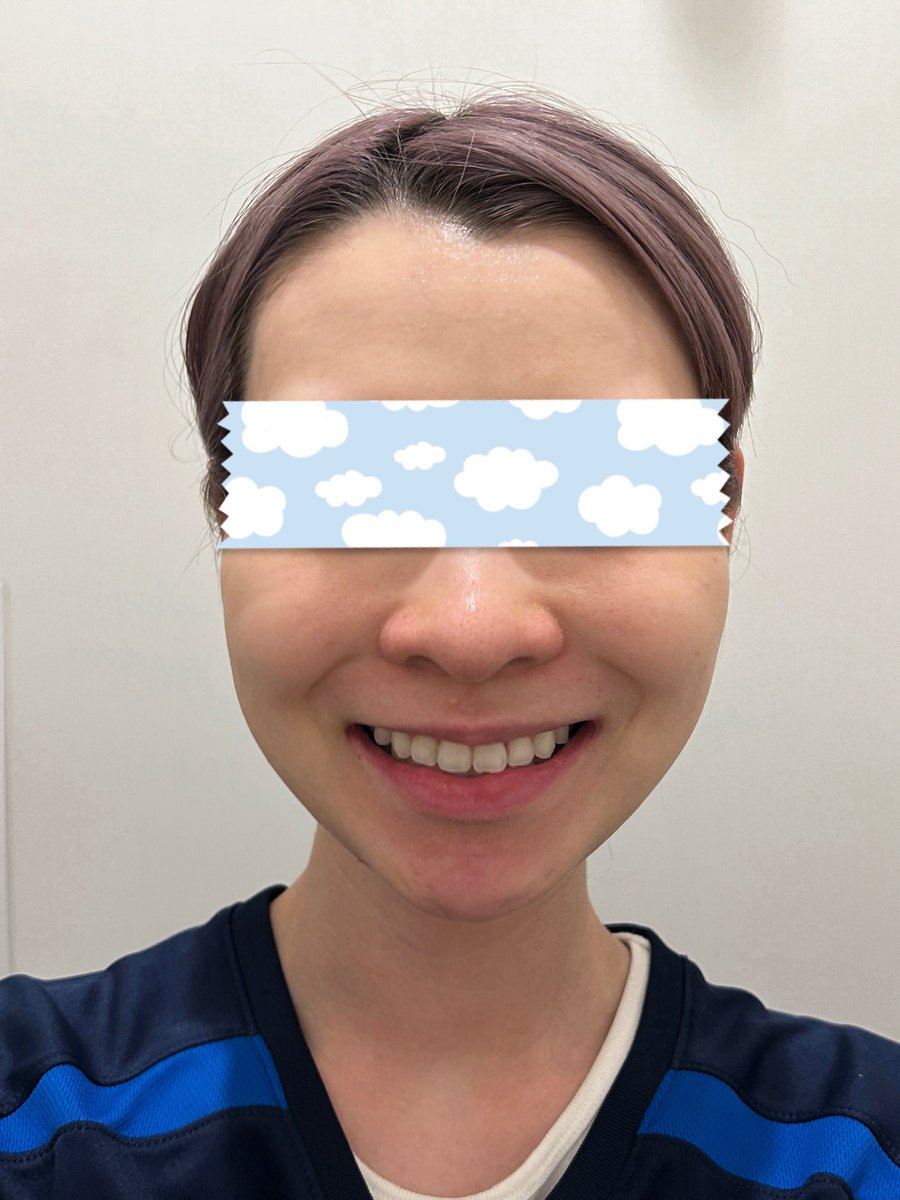 よもぎ (@my_w_23) on Twitter photo 両顎+輪郭2点 DT5カ月
遅れましたが、こちら5ヶ月時点の写真です
4ヶ月目からさらに顔が小さくなったように感じます
もう固いものも気にせず食べられるので、最近は手術を受けたことを思い出すことがほとんどなく、術前と変わらない生活ができています!
<a href="/MACSJPPS/">MACS口腔顎顔面外科«両顎・輪郭専門»</a>
<a href="/RAOLYjp/">【ラオリー】 🇰🇷韓国情報共有サイト✨</a>
#マックス口腔顎顔面外科 両顎+輪郭2点 DT5カ月
遅れましたが、こちら5ヶ月時点の写真です
4ヶ月目からさらに顔が小さくなったように感じます
もう固いものも気にせず食べられるので、最近は手術を受けたことを思い出すことがほとんどなく、術前と変わらない生活ができています!
<a href="/MACSJPPS/">MACS口腔顎顔面外科«両顎・輪郭専門»</a>
<a href="/RAOLYjp/">【ラオリー】 🇰🇷韓国情報共有サイト✨</a>
#マックス口腔顎顔面外科