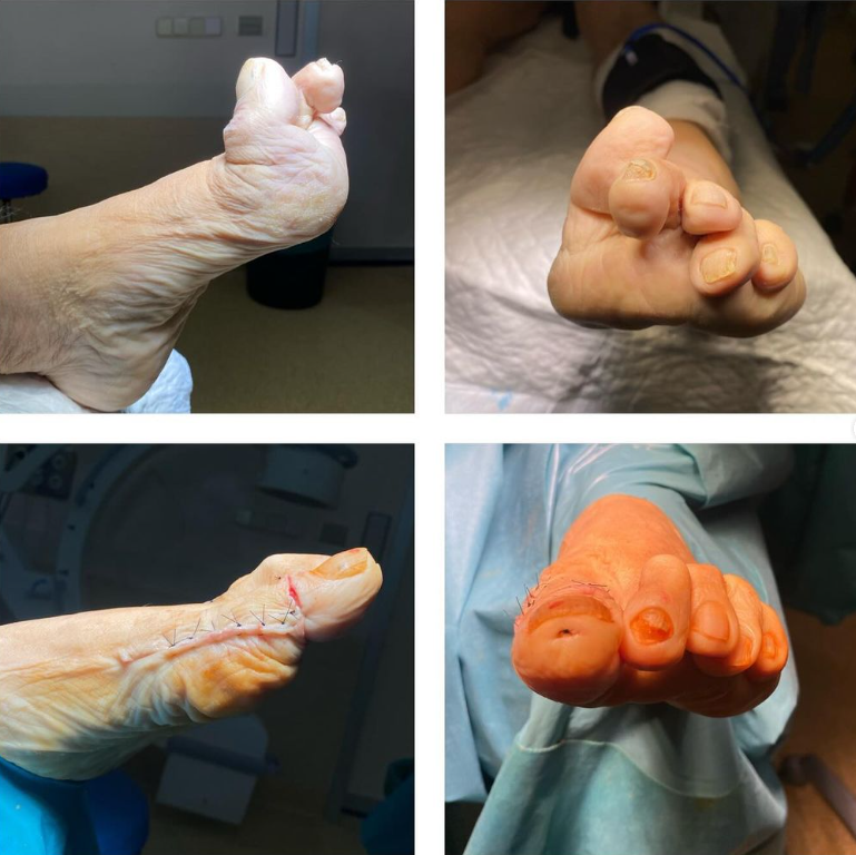 ClinicaCEMTRO (@clinicacemtro) on Twitter photo 💥Paciente con deformidad invalidante tras cirugía de #juanete hace 3 años
🦶🏼Deformidad en cock up o en garra con imposibilidad para calzado y dolor plantar en M1
🥼Qx👉🏼Artrodesis Metatarsofalángica + interfalángica
👨🏻⚕️Vía <a href="/DrSergiohorte/">Dr. Sergio Hortelano</a>
clinicacemtro.com/cemtro-premium… 💥Paciente con deformidad invalidante tras cirugía de #juanete hace 3 años
🦶🏼Deformidad en cock up o en garra con imposibilidad para calzado y dolor plantar en M1
🥼Qx👉🏼Artrodesis Metatarsofalángica + interfalángica
👨🏻⚕️Vía <a href="/DrSergiohorte/">Dr. Sergio Hortelano</a>
clinicacemtro.com/cemtro-premium…