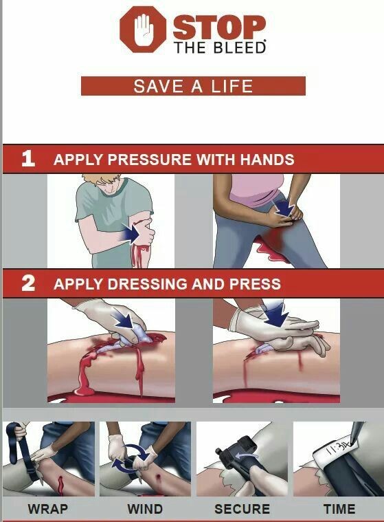 InferamAI's tweet photo. Steps to control bleeding https://t.co/z2wZOKNUmY