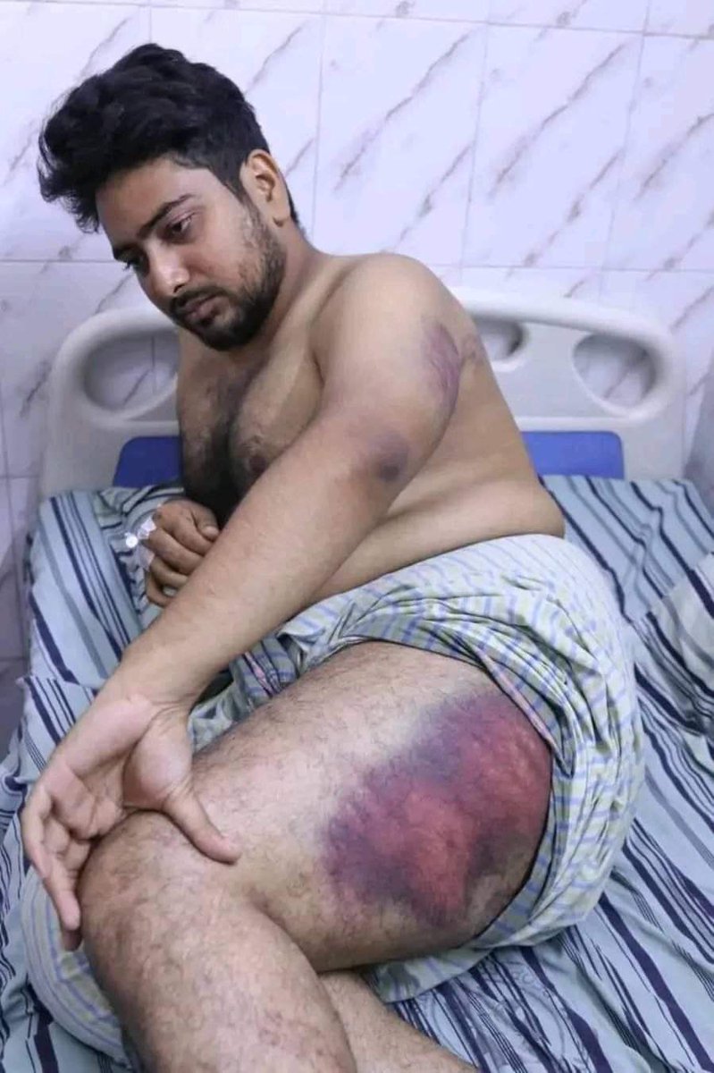 rupom's tweet image. Nahid Islam, the coordinator of Bangladesh's #QuotaReformMovement, was detained and brutally tortured by Sheikh Hasina's forces.
#SaveBangladesh #StepDownHasina
@StateDRL @usembassydhaka @USAmbBangladesh @CWhiteleyEU @GerAmbBD @HCSarahCooke @KerryKennedyRFK
@UnderSecStateJ…