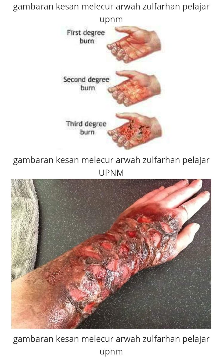 drhasifi's tweet photo. Biasanya pembuli (pembunuh) begini hanya berani apabila beramai-ramai. Memang selayaknya mereka dihukum gantung sampai mati. Kulit manusia ini kalau terkena wap panas daripada cerek pun boleh melecur, bayangkan si enam jahanam itu mereka tekap kulit arwah Zulfarhan dengan steam iron bersuhu 100° Celsius sebanyak 90 kali termasuk di kemaluan. Sehinggakan melekat kulit dan darah arwah di seterika. Tiada manusia yang sanggup buat perkara begini melainkan dalam dirinya memang sudah tiada secebis kebaikan. Hukuman mati adalah selayaknya untuk mereka.
