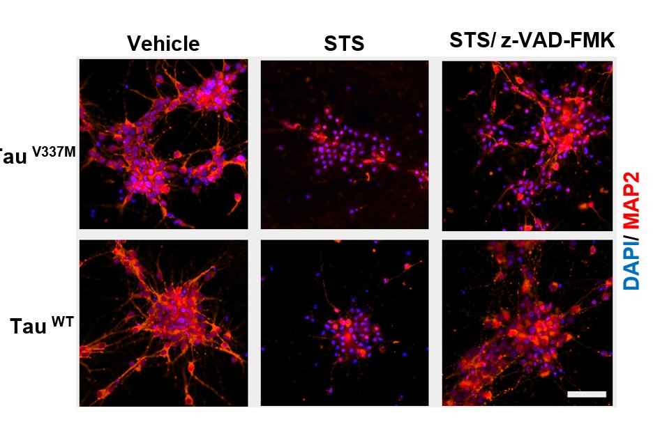grinberg_t's tweet photo. Excited to share our latest  on #Tauopathies! 🧠 Using iPSC der-neurons with MAPT V337M mutations and novel antibodies, we showed  caspase-6 cleaved tau plays a neurotoxic role. Caspase inhibitors prevented this toxicity, New therapeutic avenues? https://t.co/xnOztpQEPy @UCSFmac https://t.co/kmv0V9gT0L