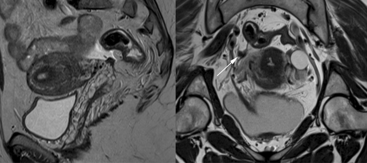 European Radiology (@eurradiology) on Twitter photo In this study, <a href="/NaggaraIsabelle/">Isabelle Thomassin-Naggara</a> et al. demonstrate that bowel preparation enhances #MRI diagnostic accuracy when detecting deep endometriosis lesions in the torus/uterosacral ligament.
#EuropeanRadiology
🔗 buff.ly/3Ls2Niu In this study, <a href="/NaggaraIsabelle/">Isabelle Thomassin-Naggara</a> et al. demonstrate that bowel preparation enhances #MRI diagnostic accuracy when detecting deep endometriosis lesions in the torus/uterosacral ligament.
#EuropeanRadiology
🔗 buff.ly/3Ls2Niu