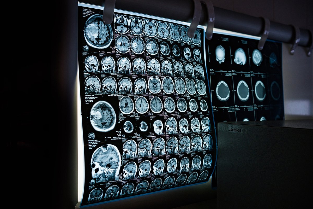 Kan een hersentumor gerichter bestraald worden met de recent ontwikkelde MRI- techniek Deuterium Metabolic Imaging? Om hier achter te komen gaat hersentumoronderzoeker en <a href="/ScienceFaces/">Faces of Science</a>  Patrick Tang naar Cambridge met een KNAW Van Leersum beurs. Lees meer: knaw.nl/nl/knaw-van-le…