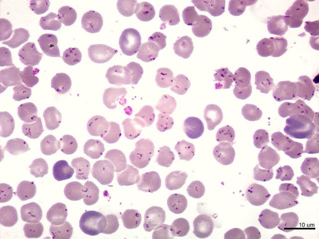 A 9yr ♂️ south American with fever,headache,anaemia, generalized body pain, lymphadenopathy,hepatomegaly then later presents with this skin lesions. Peripheral blood smear done showed 👇.What is the diagnosis?
Causative organism and what transmit this infection?
Treatment?