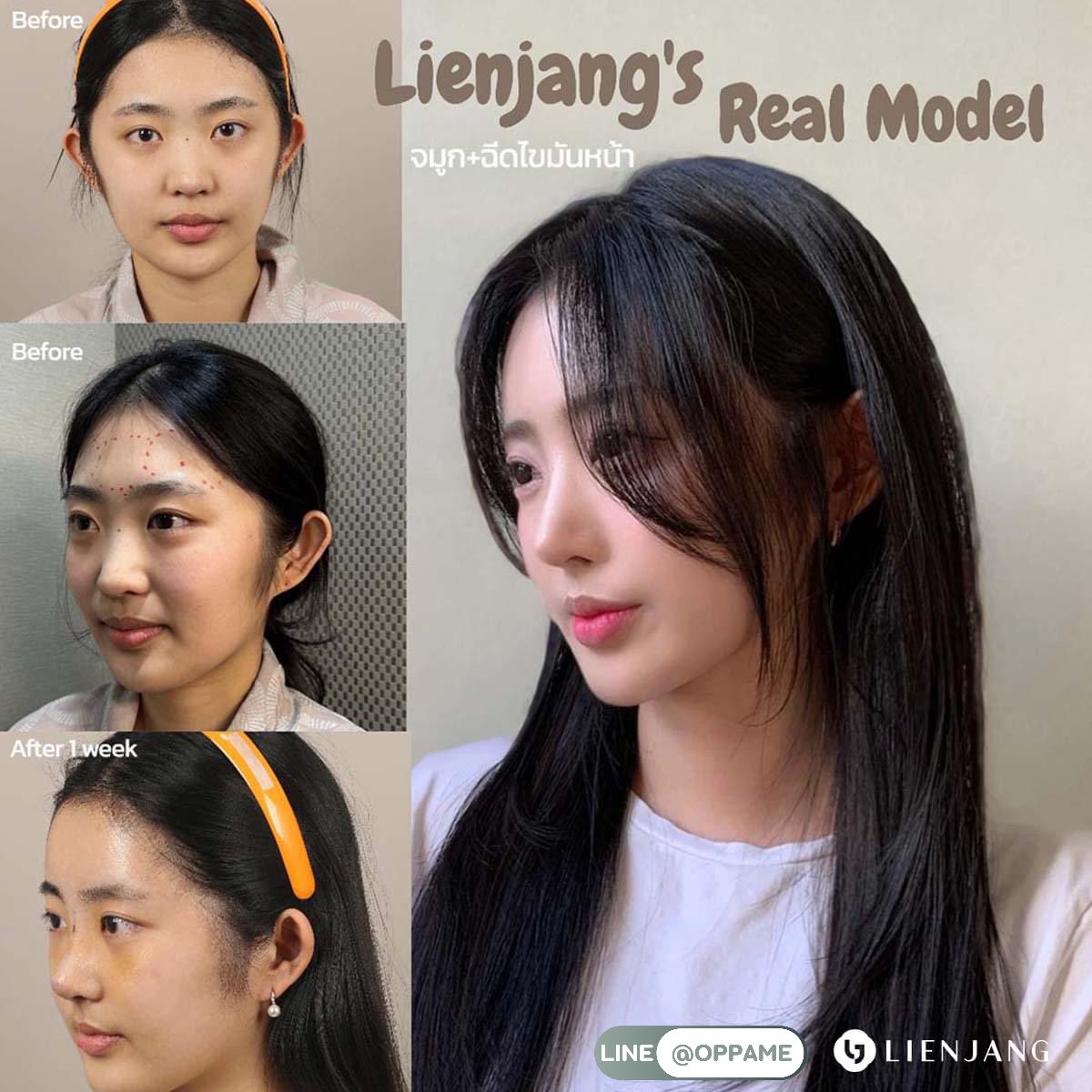 oppamethailand's tweet image. ใครชอบจมูกสไตล์นี้ แนะนำเลย รพ.ลีเอนจาง มีราคาพิเศษอยู่นะคะ 🎉

🔰 ปรึกษาศัลยกรรมเกาหลีฟรี ประสบการณ์ 10 ปี
LINE @oppame หรือคลิก connextchat.com/oppame
Website oppame.com
#oppame #ศัลยกรรมเกาหลี #อันดับ1