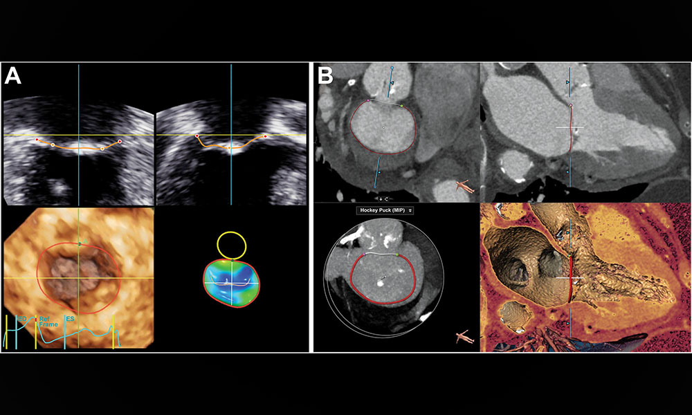 Mitral annulus measurements are critical for effective transcatheter mitral valve implantation preprocedural planning.

This pilot study aimed to evaluate the potential of 3D TTE, in comparison to CT, as a method to screen patients for excessive MA size. bit.ly/3zMuFLJ